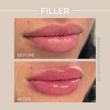 lip filler, injectables, medical aesthetics, before and after, aesthetics, injecting